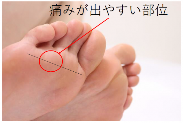 モートン