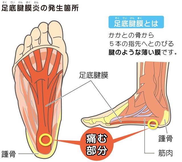 うら 筋 痛い あし が の の 足の裏を押すと痛い時は要注意！足底腱膜炎の症状と治療方法とは？