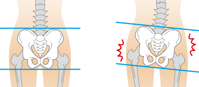 腰痛