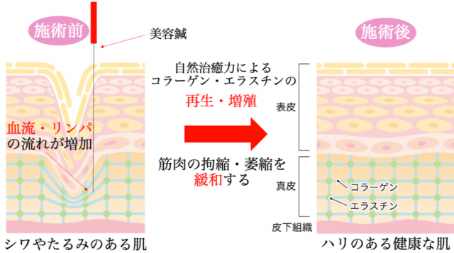 鍼の効果