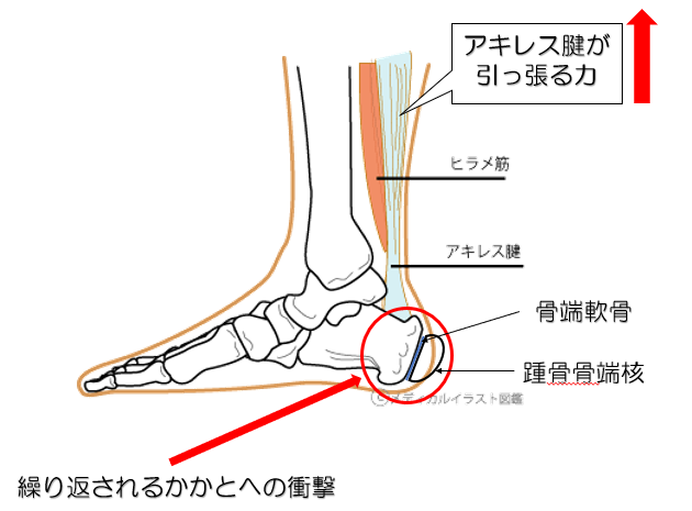 セーバー病