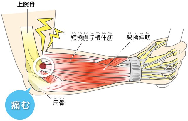 テニス肘
