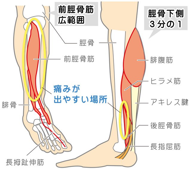 シンスプリント