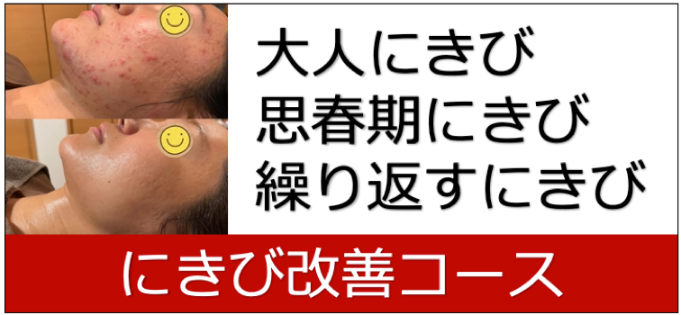 ニキビ改善コース